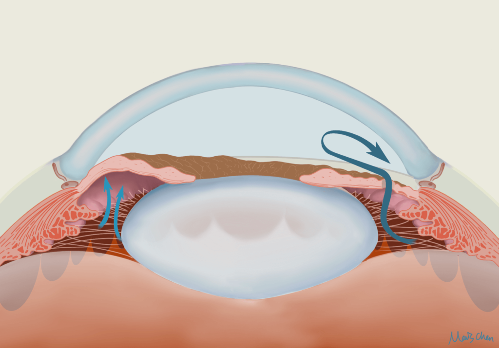 Patent Laser Peripheral Iridotomy