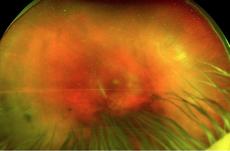 Optos imaging of the fundus of the right eye | Eyes of the Month | Queensland Eye and Retina Specialist