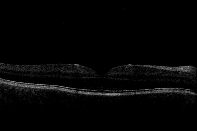 OCT scan of the right eye | Eyes of the Month | Queensland Eye and Retina Specialist